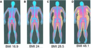 Yes, You Can Be 'Big Boned' (But That's Not Why You're Overweight